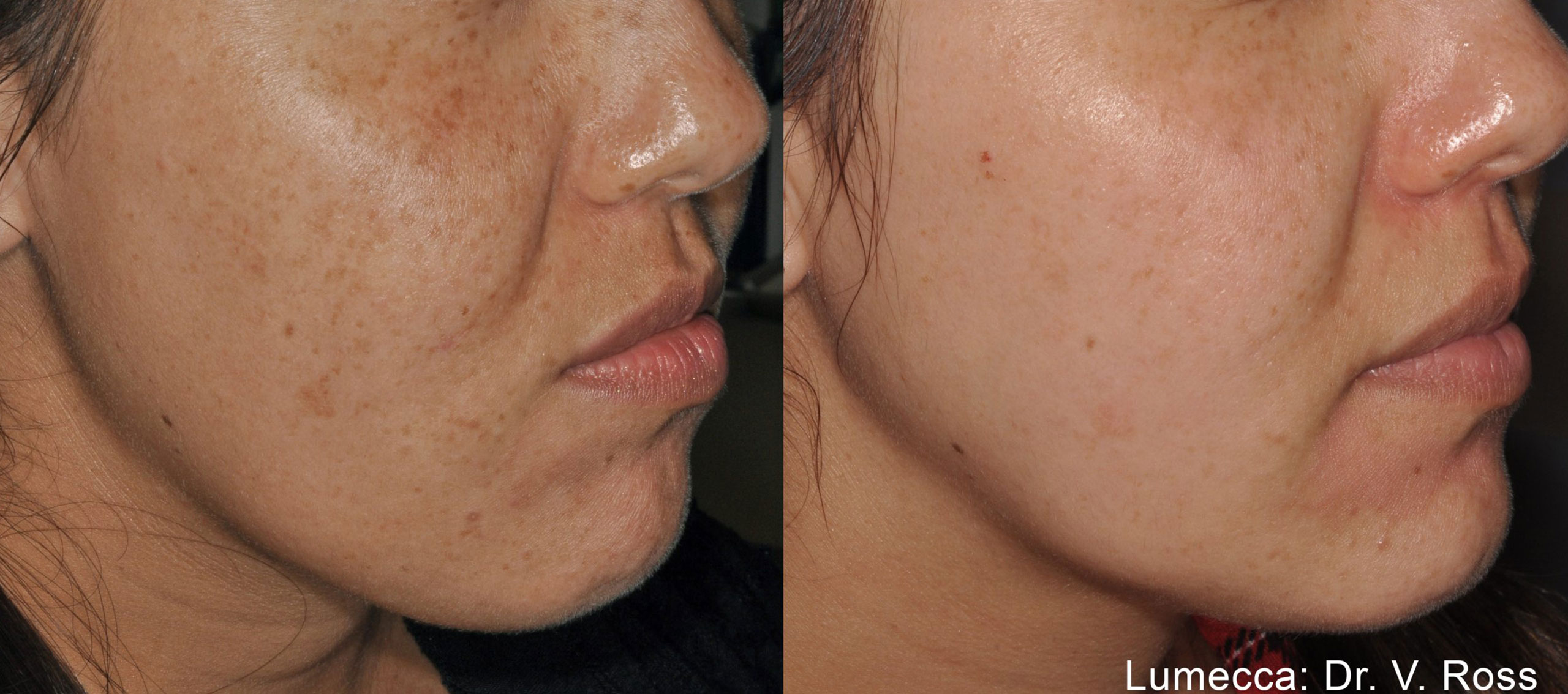 lumecca-before-after-dr-h-roberts-preview-9