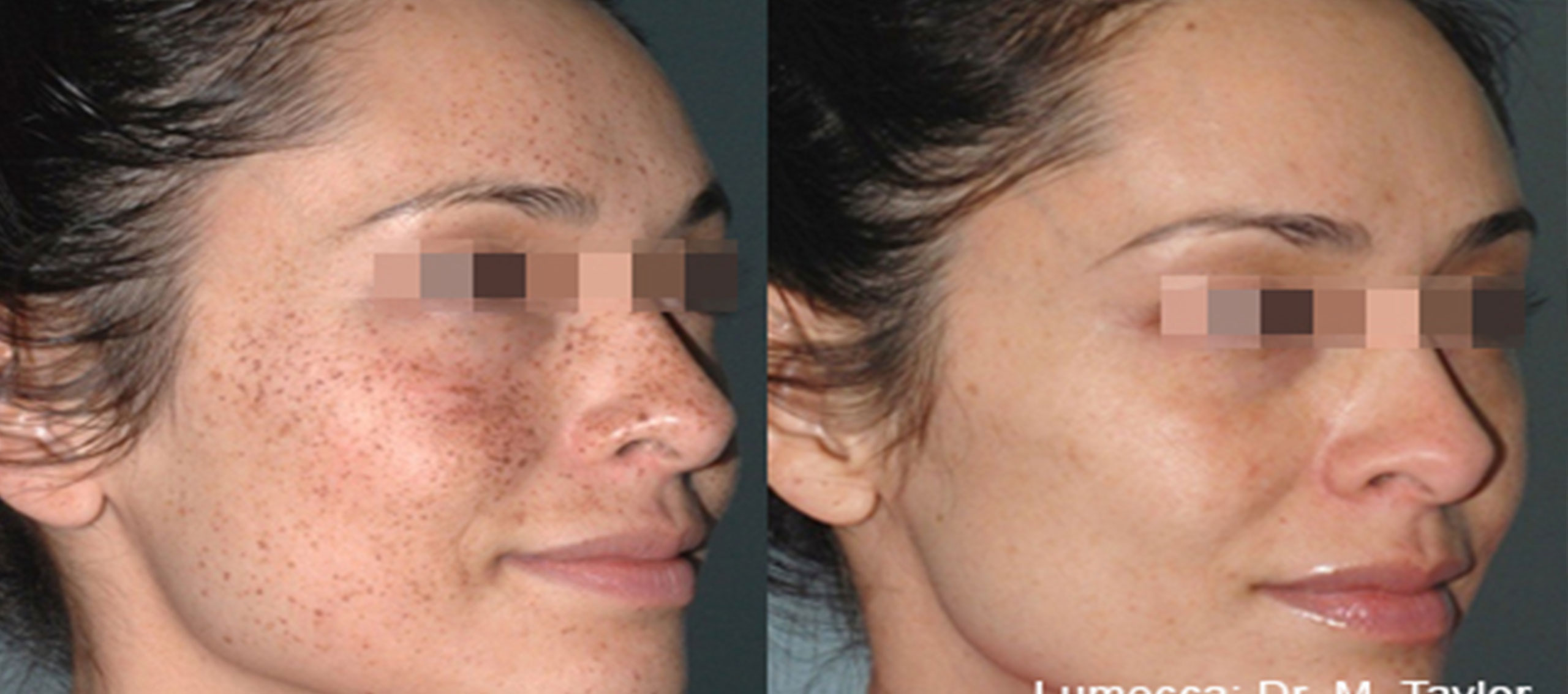 lumecca-before-after-dr-h-roberts-preview-9